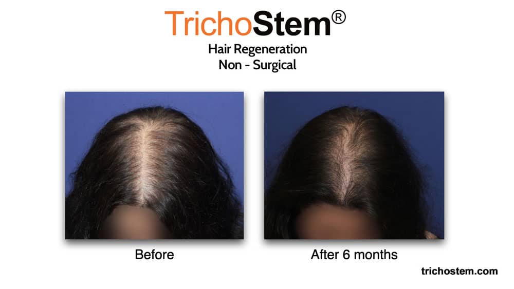Hair Regeneration female pattern hair loss before and after 6 months