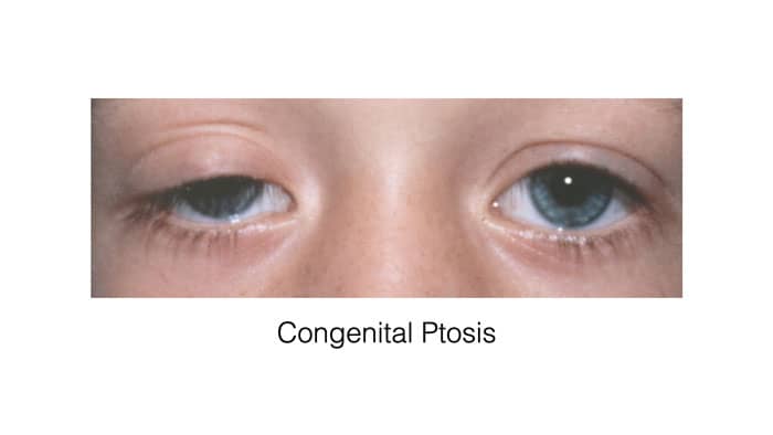 congenital ptosis example