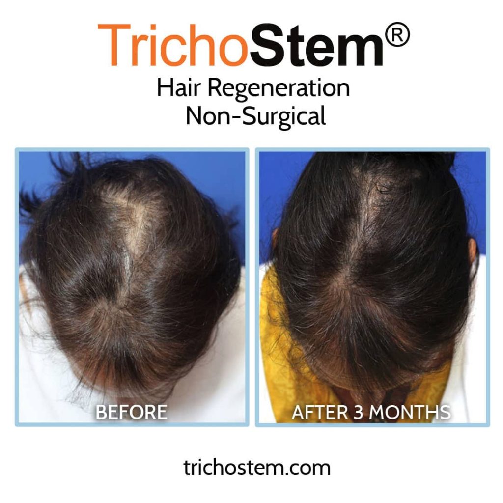 female pattern hair loss 3 months before and after Hair Regeneration