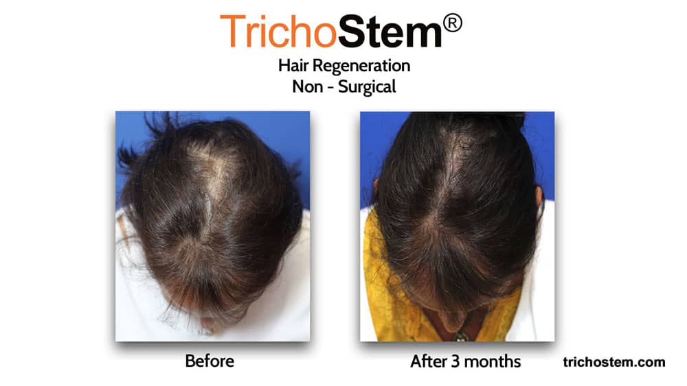 female pattern hair loss 3 months after Hair Regeneration