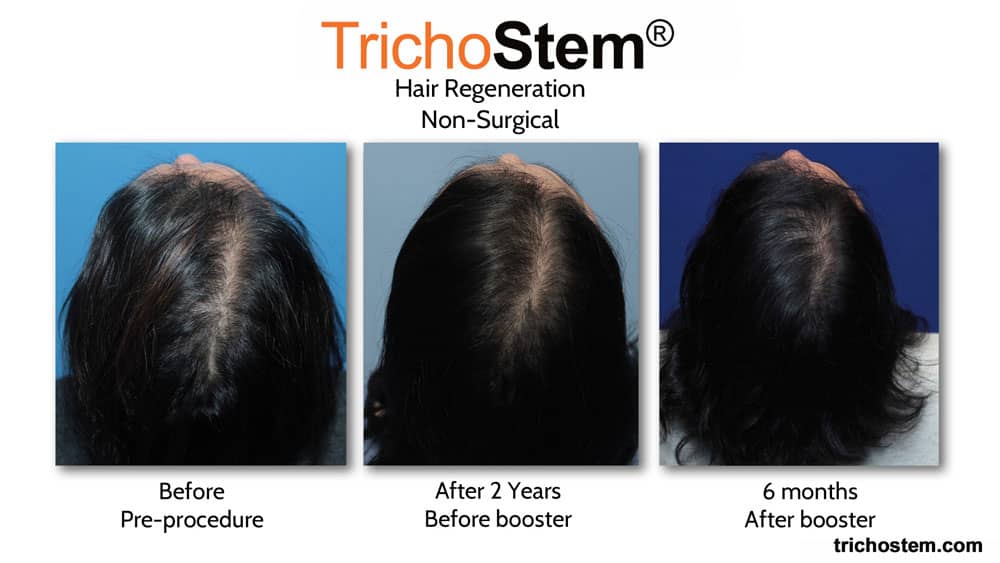 female pattern hair loss before and after TrichoStem Hair Regeneration