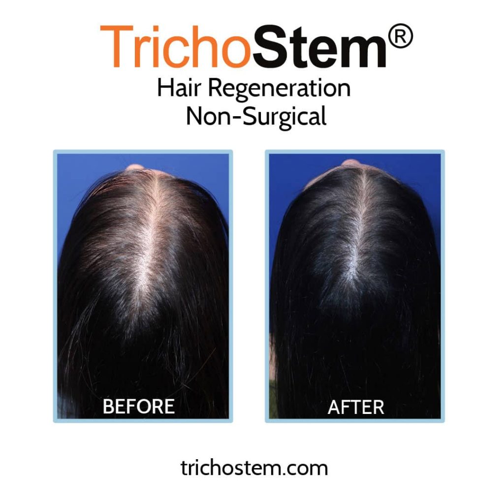 female pattern hair loss before regeneration treatment before and after
