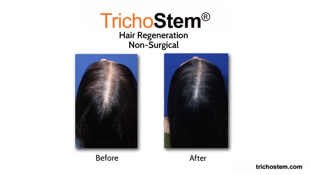 female pattern hair loss treatment before and after hair regeneration treatment