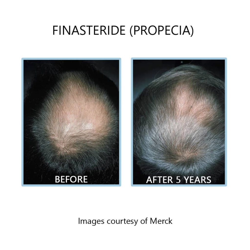 Finasteride propecia for men before and after
