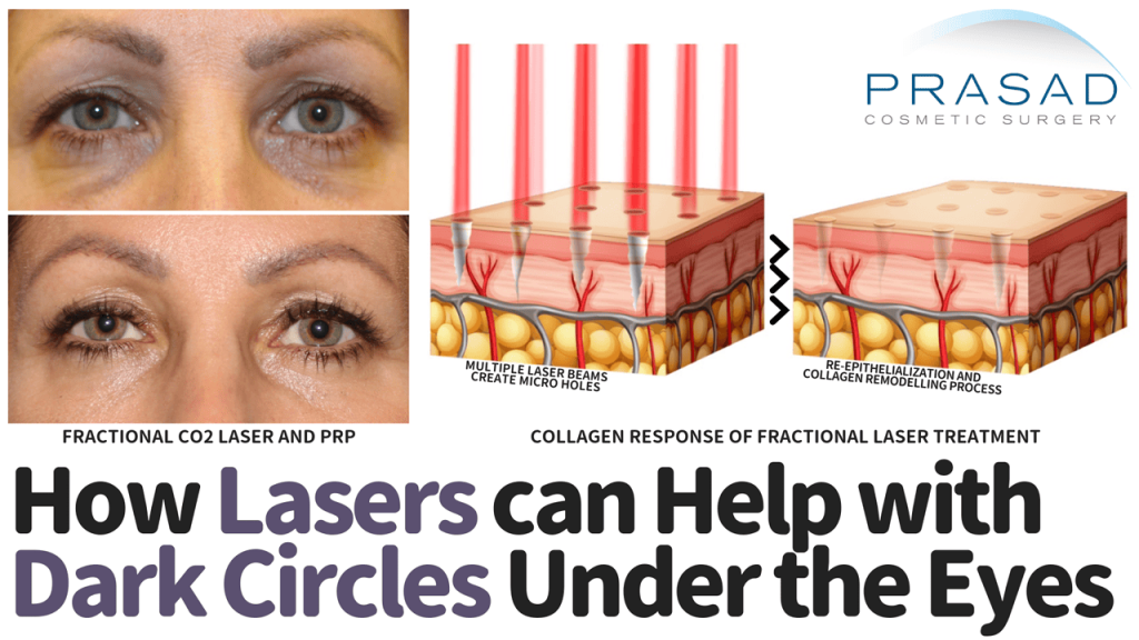 How lasers can help with dark circles under eyes