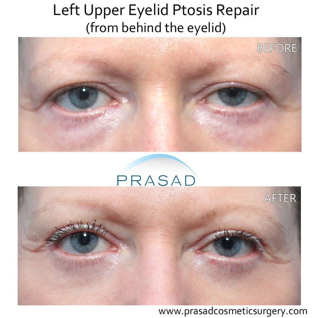 ptosis correction surgery before and after