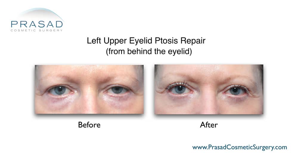 Left upper eyelid ptosis correction before and after