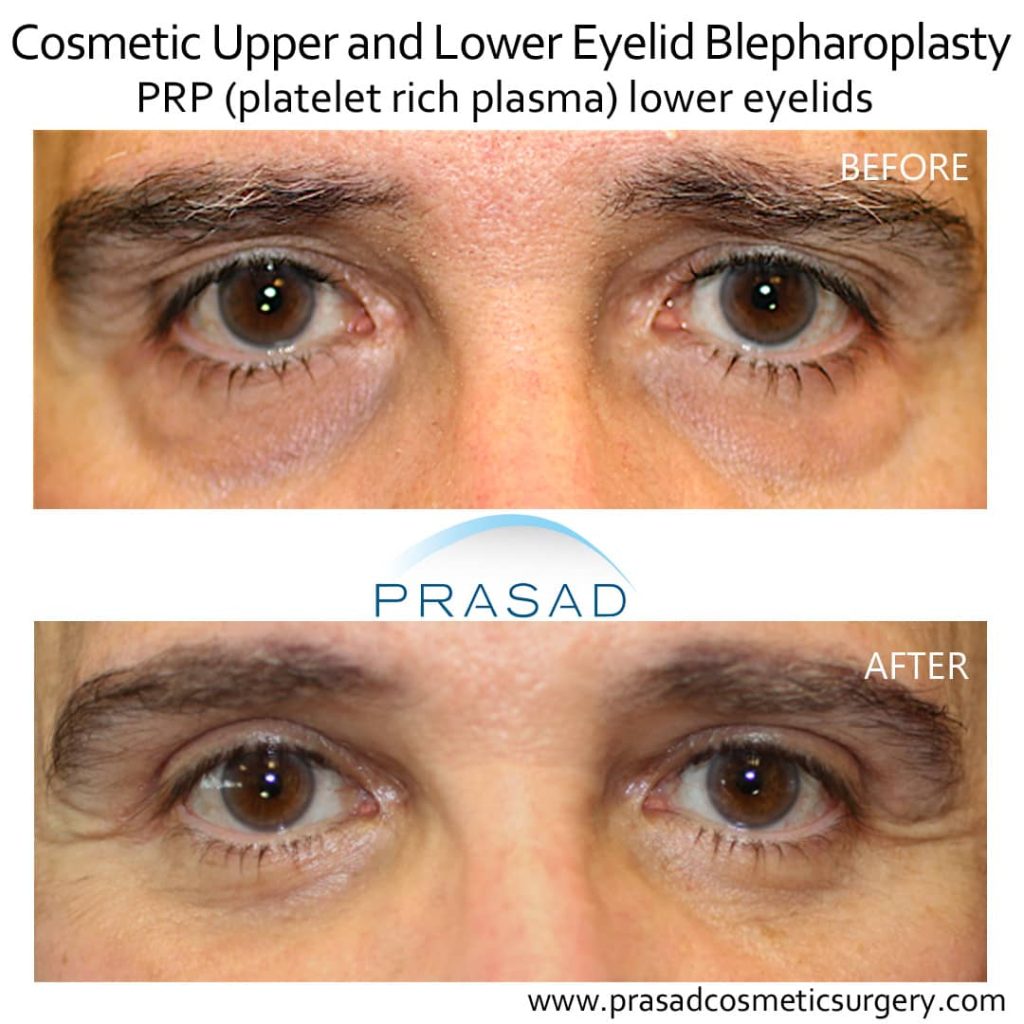 Upper and lower blepharoplasty with PRP for under eyes