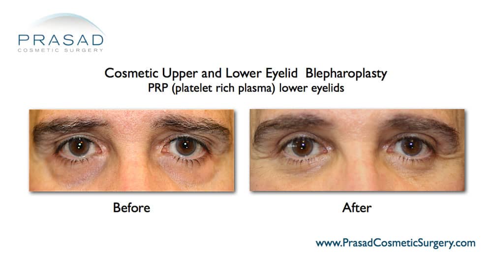 Upper and lower eyelid surgery with PRP for under eyes