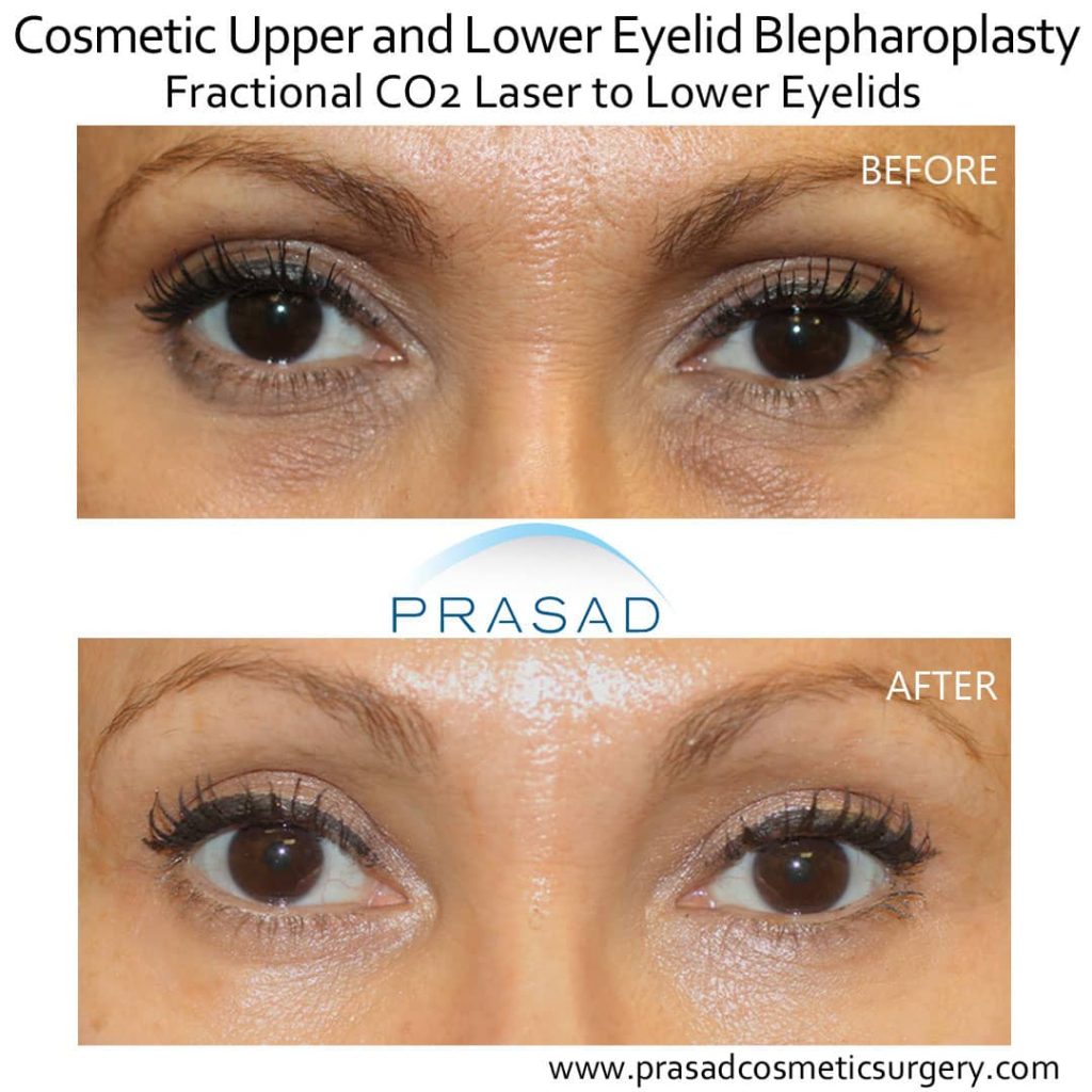 Upper and lower eyelid surgery with PRP and laser treatment for dark circles under eyes