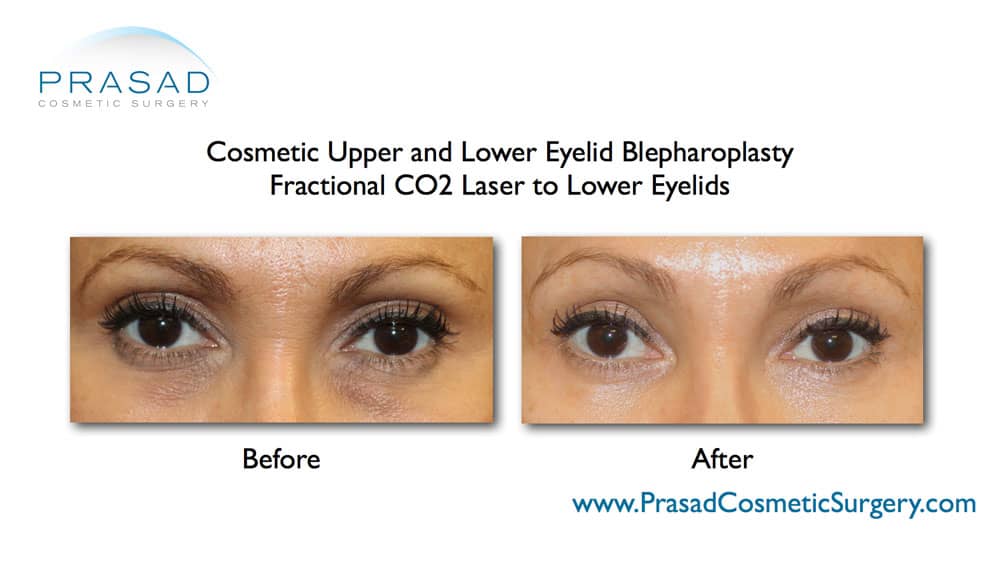 Upper and lower blepharoplasty with PRP and laser treatment for dark circles under eyes