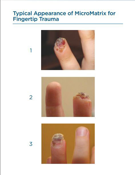 acell healing finger trauma