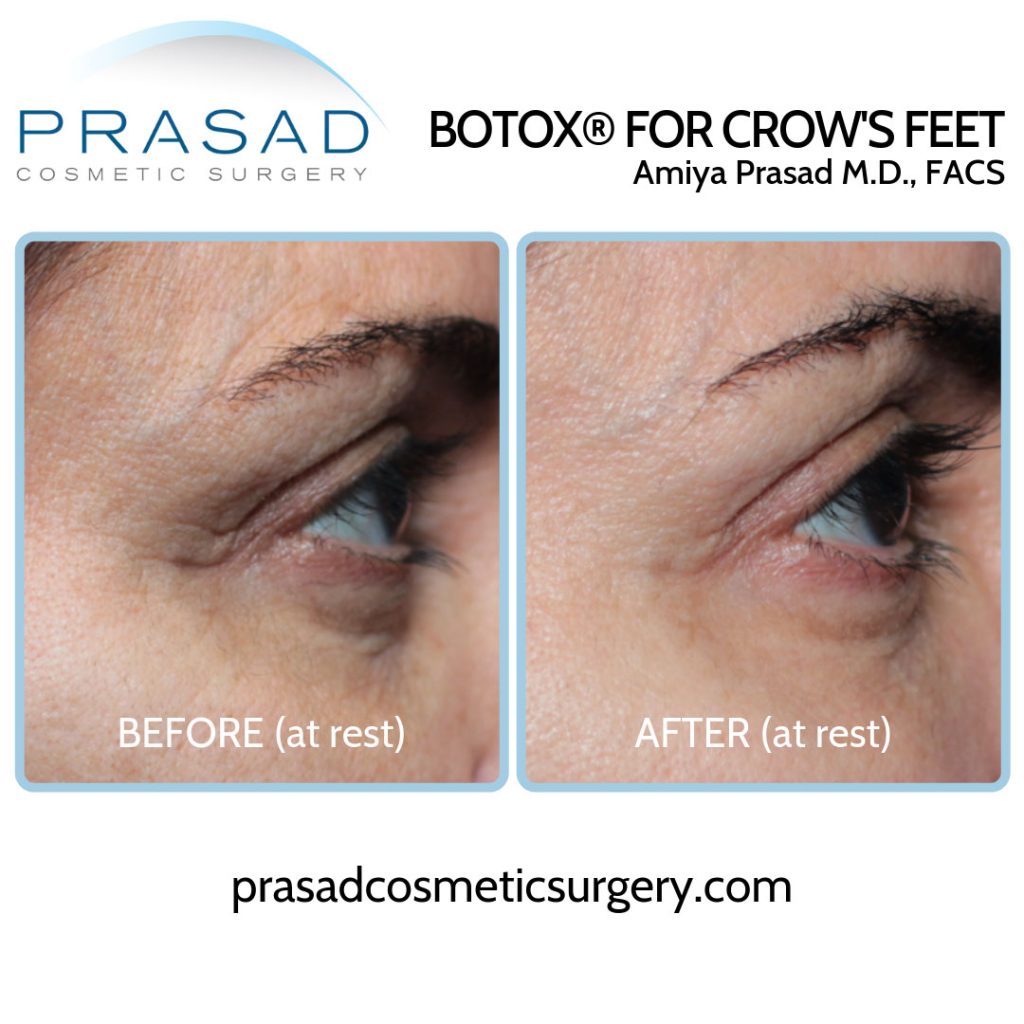 crow's feet lines and under eye wrinkles before and after Botox performed by Dr Amiya Prasad
