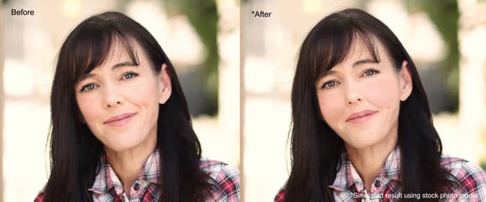 simulated result of doughy result (cheek fillers) using stock photo model before and after