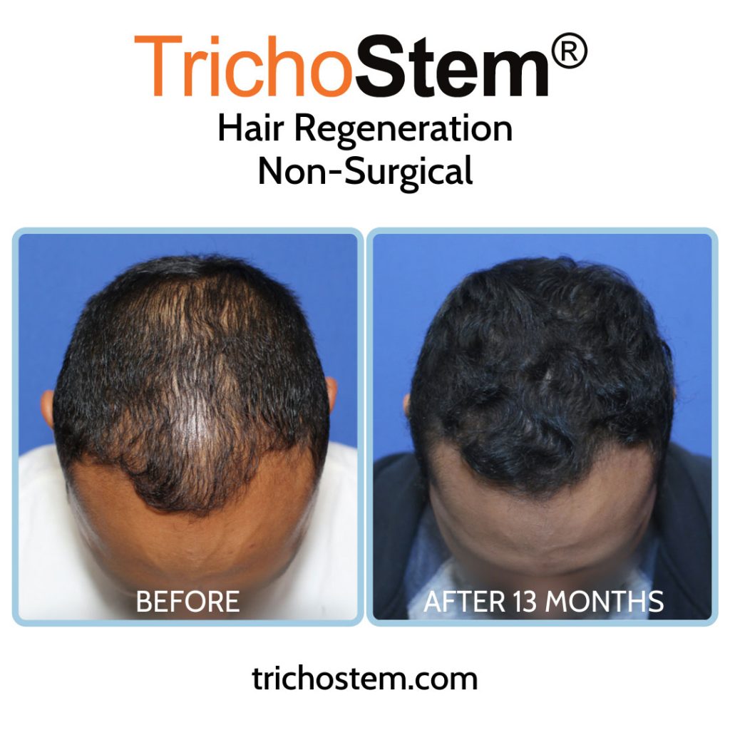 Hair Regeneration Acell PRP before and after 13 months