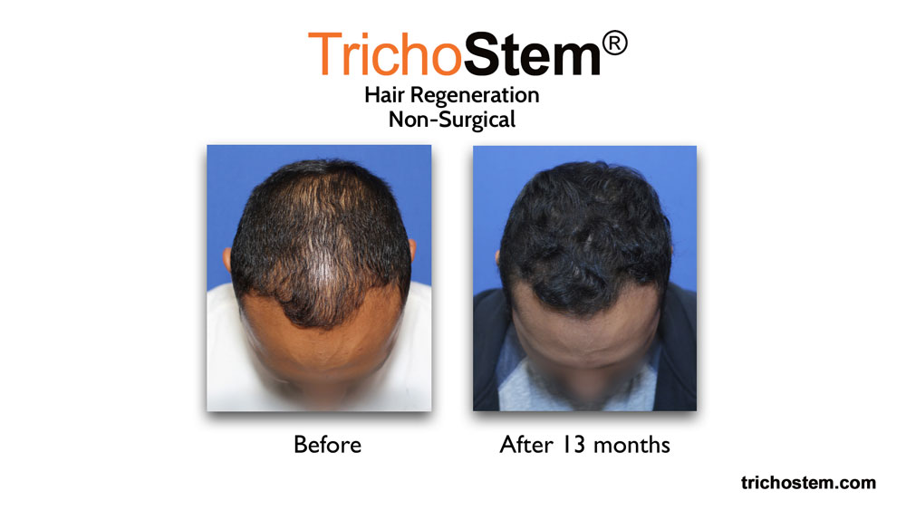 Acell PRP Hair Regeneration before and after 13 months top of the head view