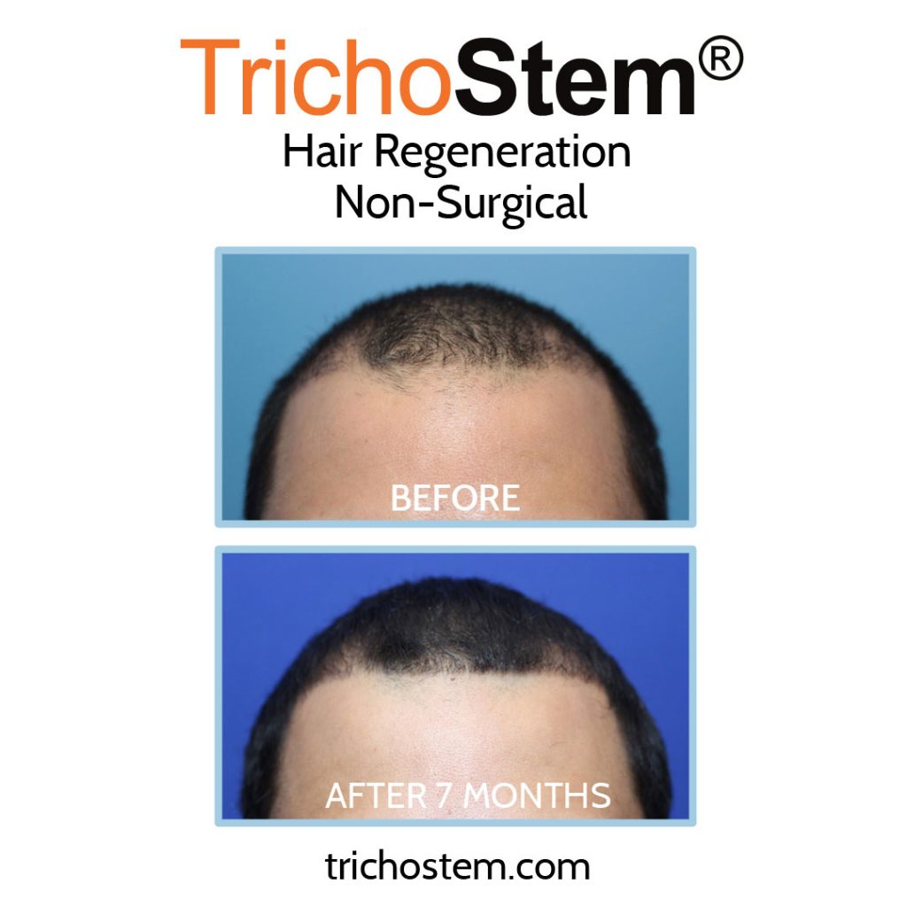 non-surgical Hair Regeneration before and after