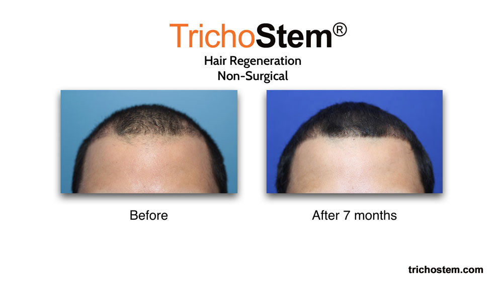 Hair Regeneration before and after