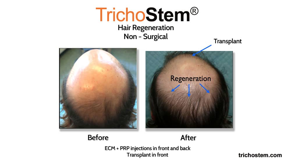 Acell PRP injection for hair loss before and after