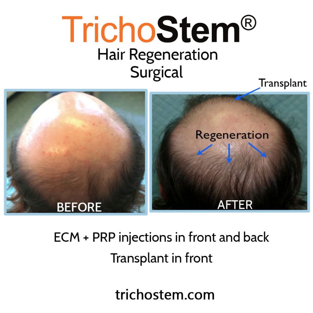 Acell+PRP injection before and after