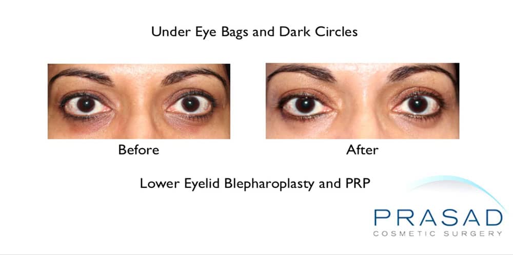Treating Concurrent Under Eye Puffiness and Hollowness before and after