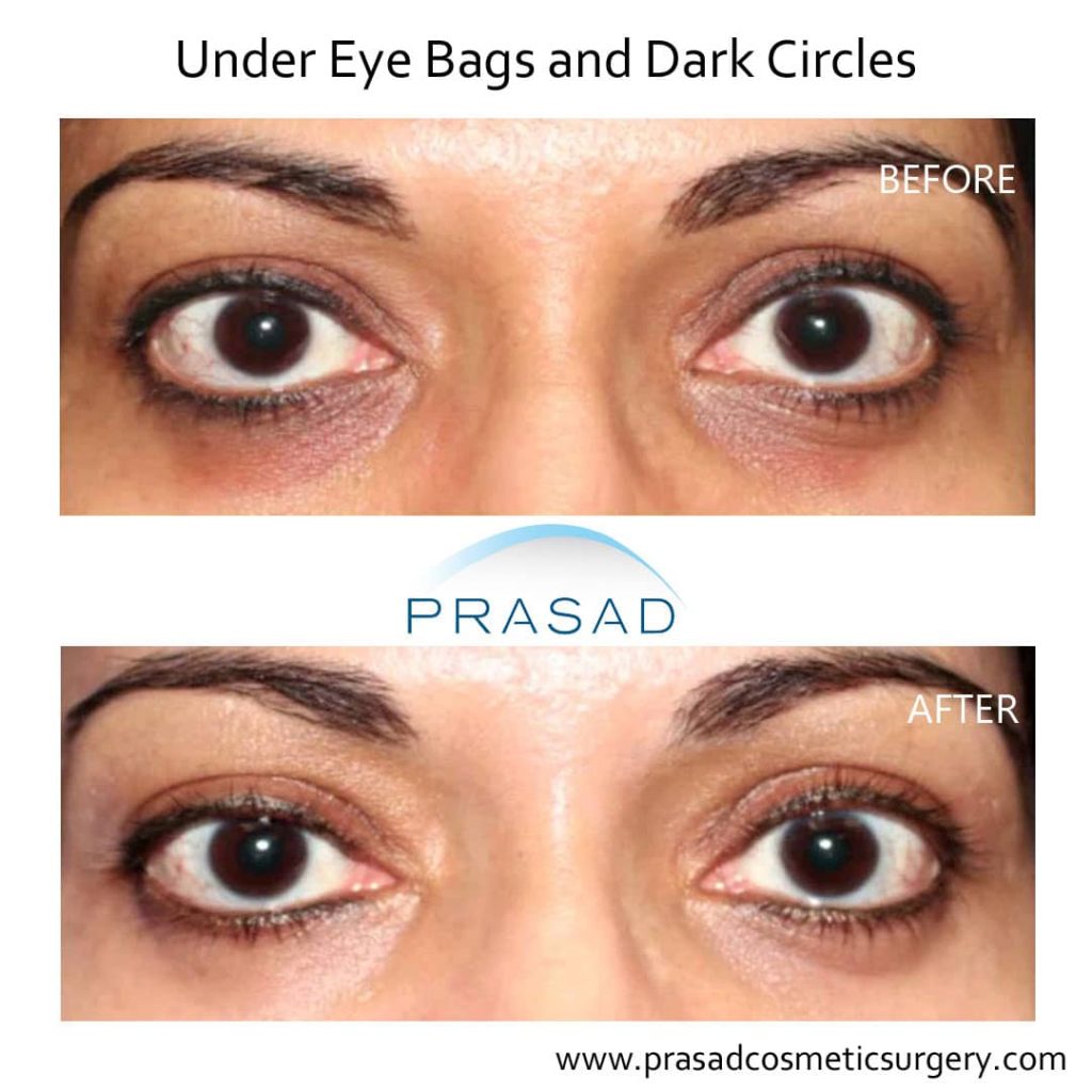 before and after Treating Concurrent Under Eye Puffiness and Hollowness