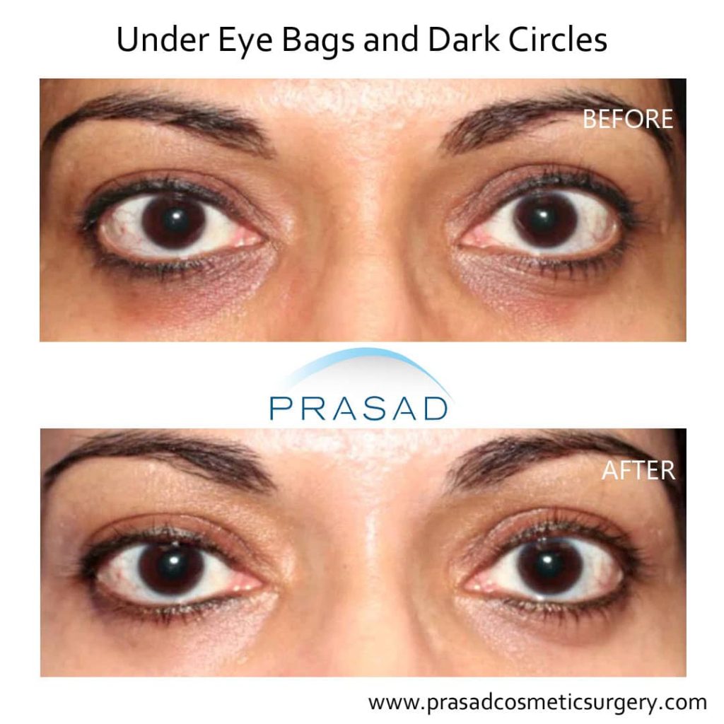 Treating Concurrent Under Eye Puffiness and Hollowness - Prasad Cosmetic  Surgery