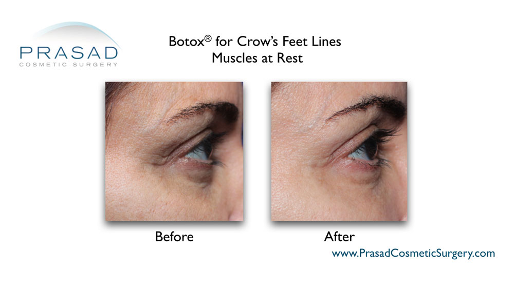 crow's feet lines before and after Botox performed by Dr Amiya Prasad
