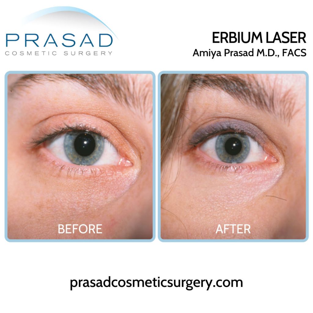 erbium laser for under eyes before and after
