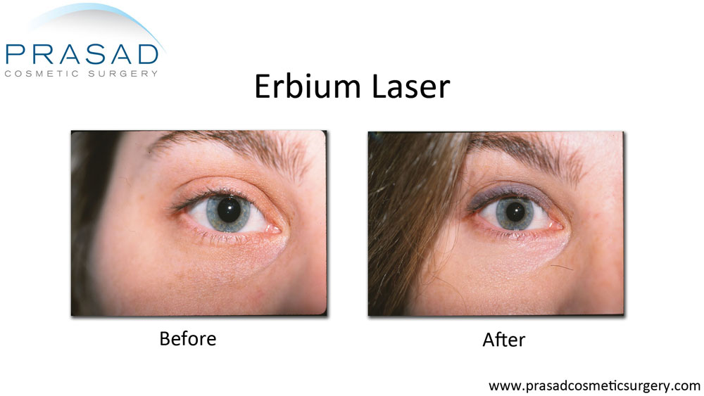 erbium laser before and after for under eyes treatment