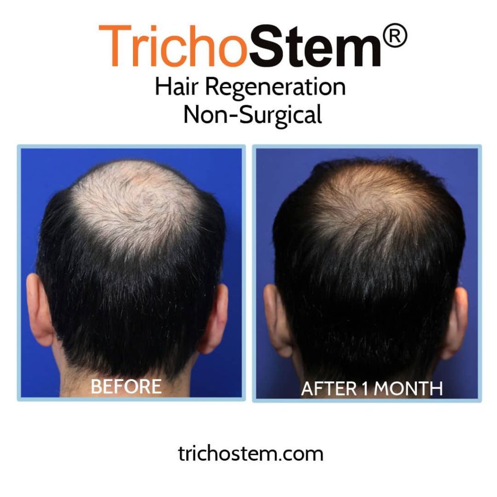 acell prp Hair Regeneration before and after