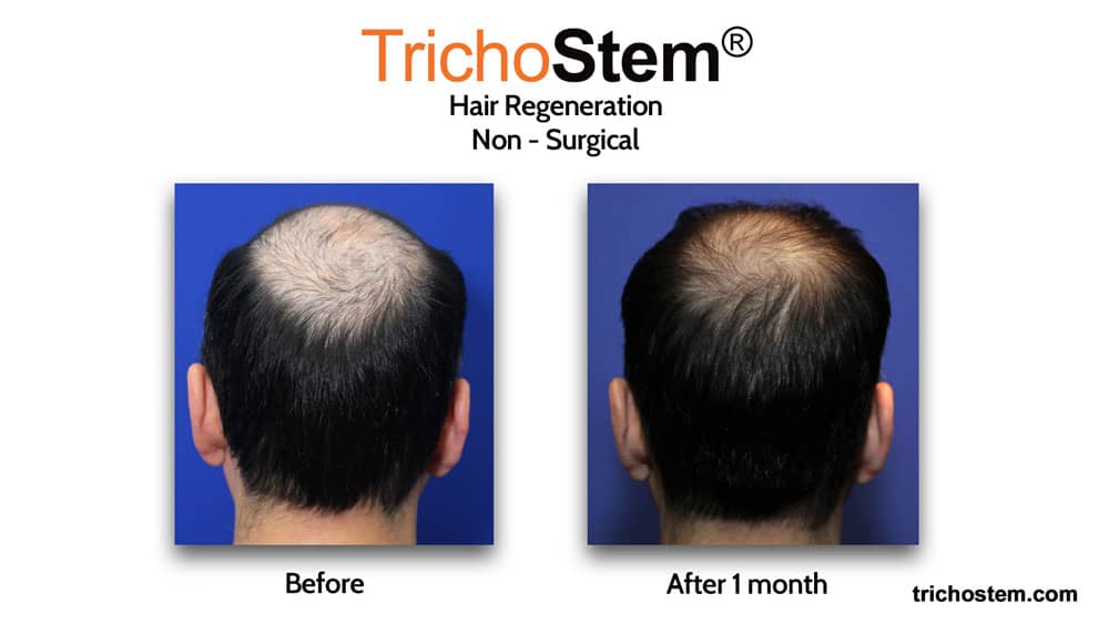 TrichoStem Hair Regeneration before and after