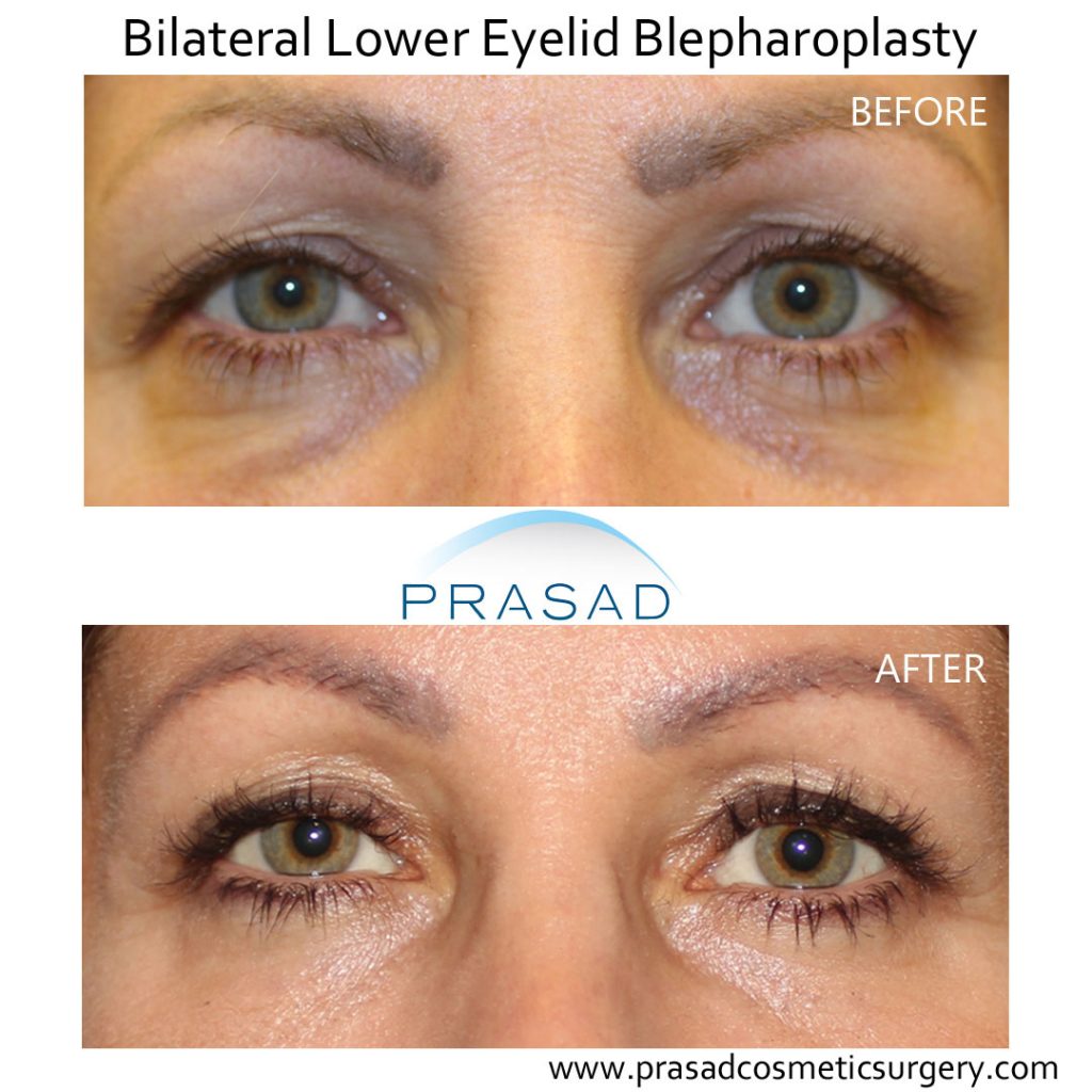 lower blepharoplasty with laser for under eye wrinkles treatment