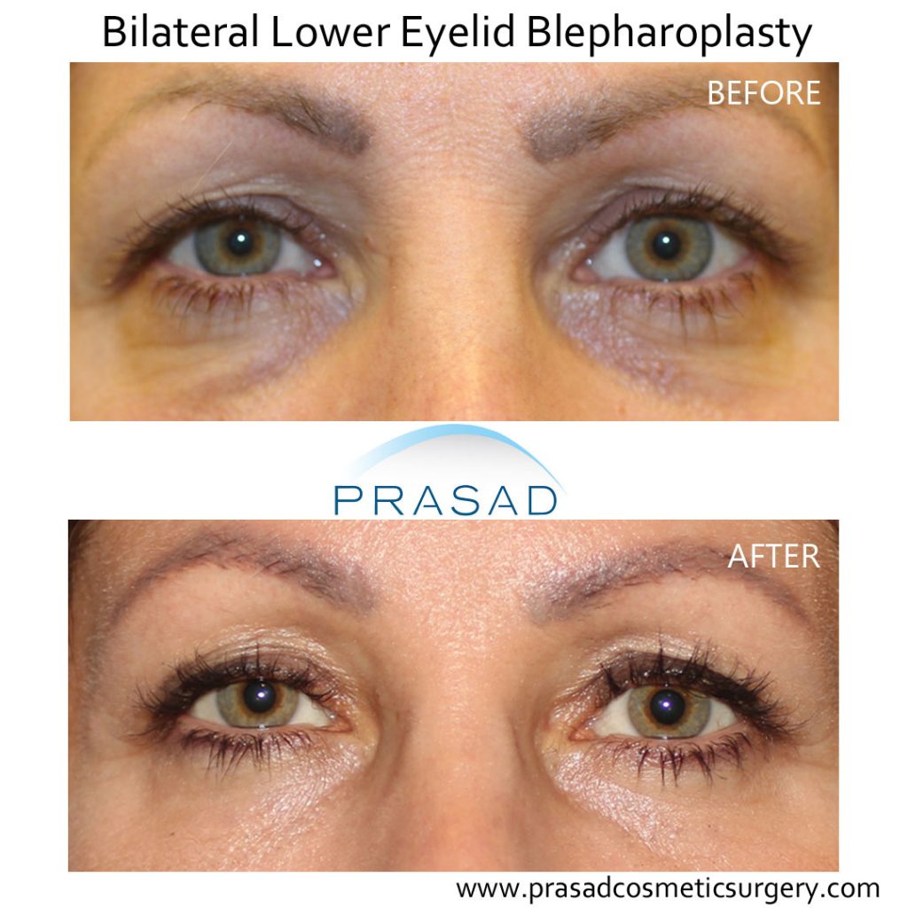 Best Treatment for Under Eye Wrinkles Fillers Surgery or Laser