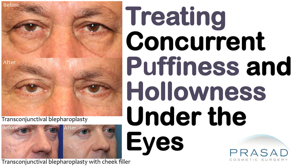 treating concurrent puffiness and hollowness under the eyes