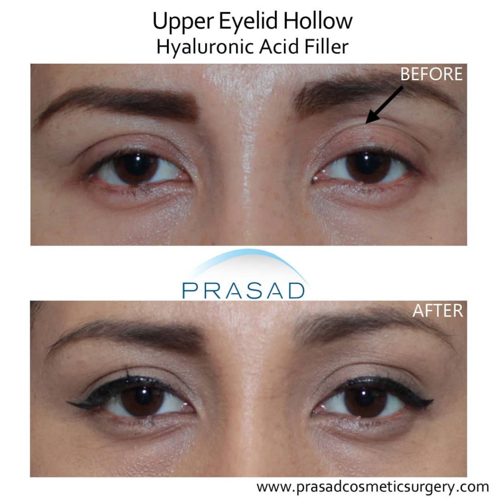 uneven eyes non-surgical treatment with fillers before and after results