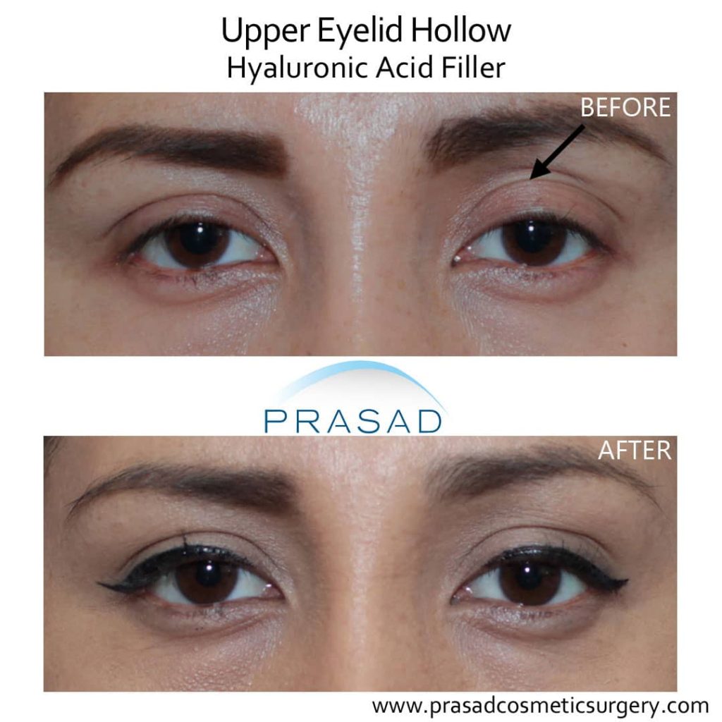 revision uneven eyelids