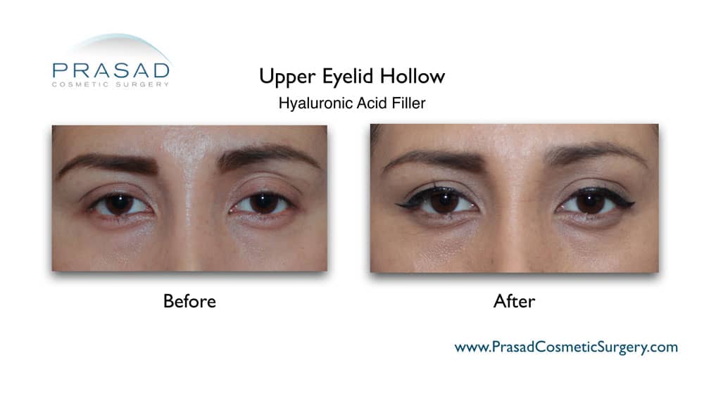 uneven eyes treatment with hyaluronic acid fillers for upper eyelid hollowing before and after