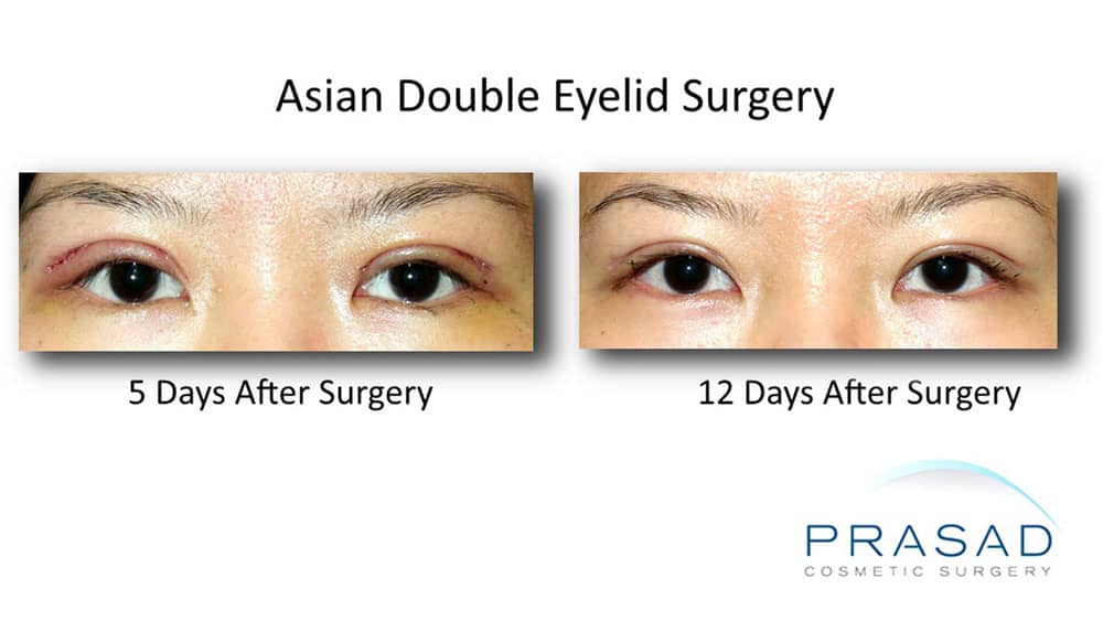 Double eyelid blepharoplasty recovery after 1 week and 2 weeks of young female patient