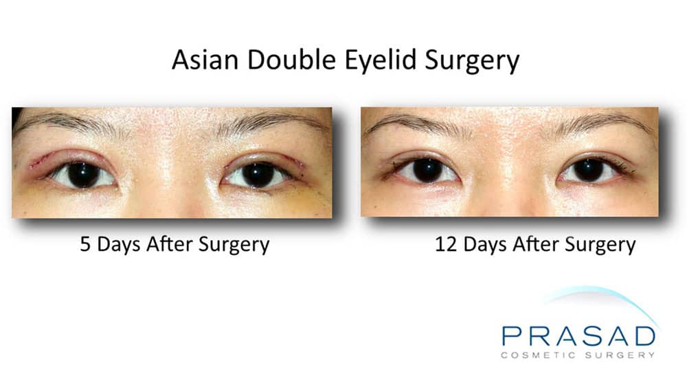 Double eyelid deals surgery swelling time