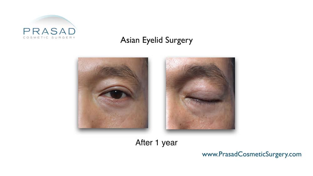 Asian blepharoplasty healing after 1 year of male patient