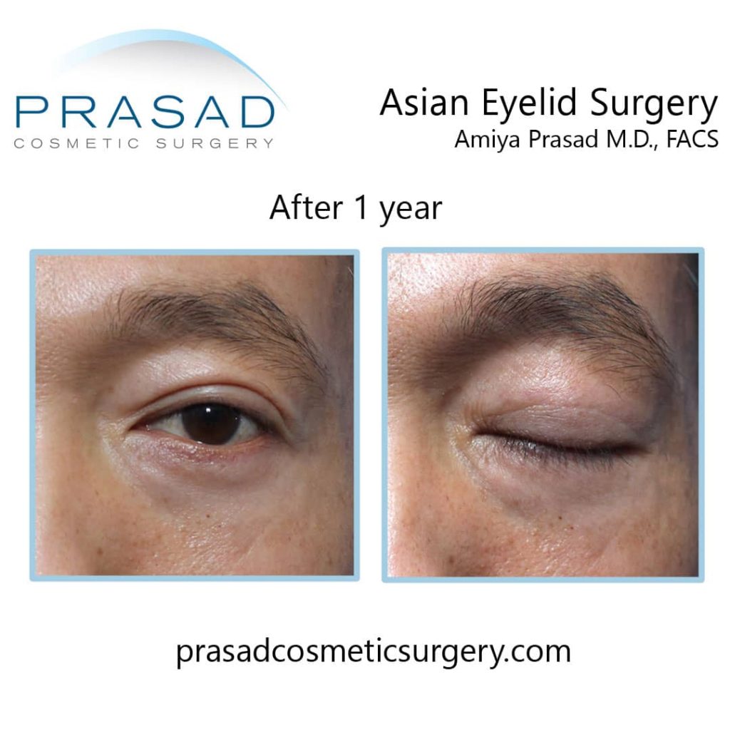 Asian double eyelid blepharoplasty healing/recovery after 1 year of male patient