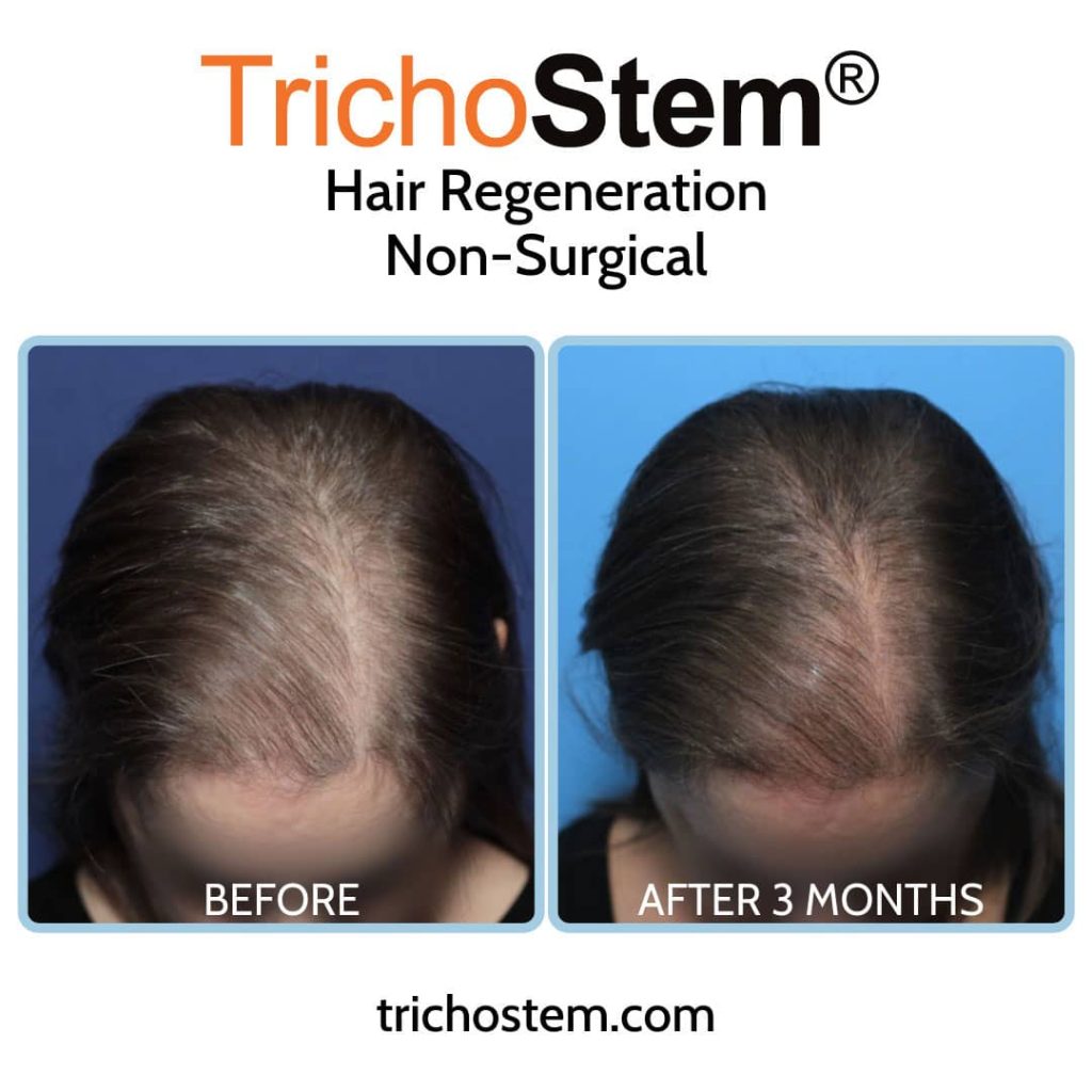 Before and after hair regeneration treatment for female pattern hair thinning or hair loss due to menopause