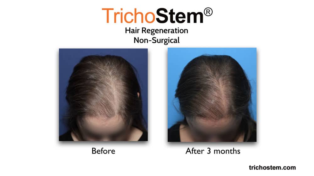 before and after Trichostem Hair Regeneration treatment for female pattern hair loss and hair loss due to menopause