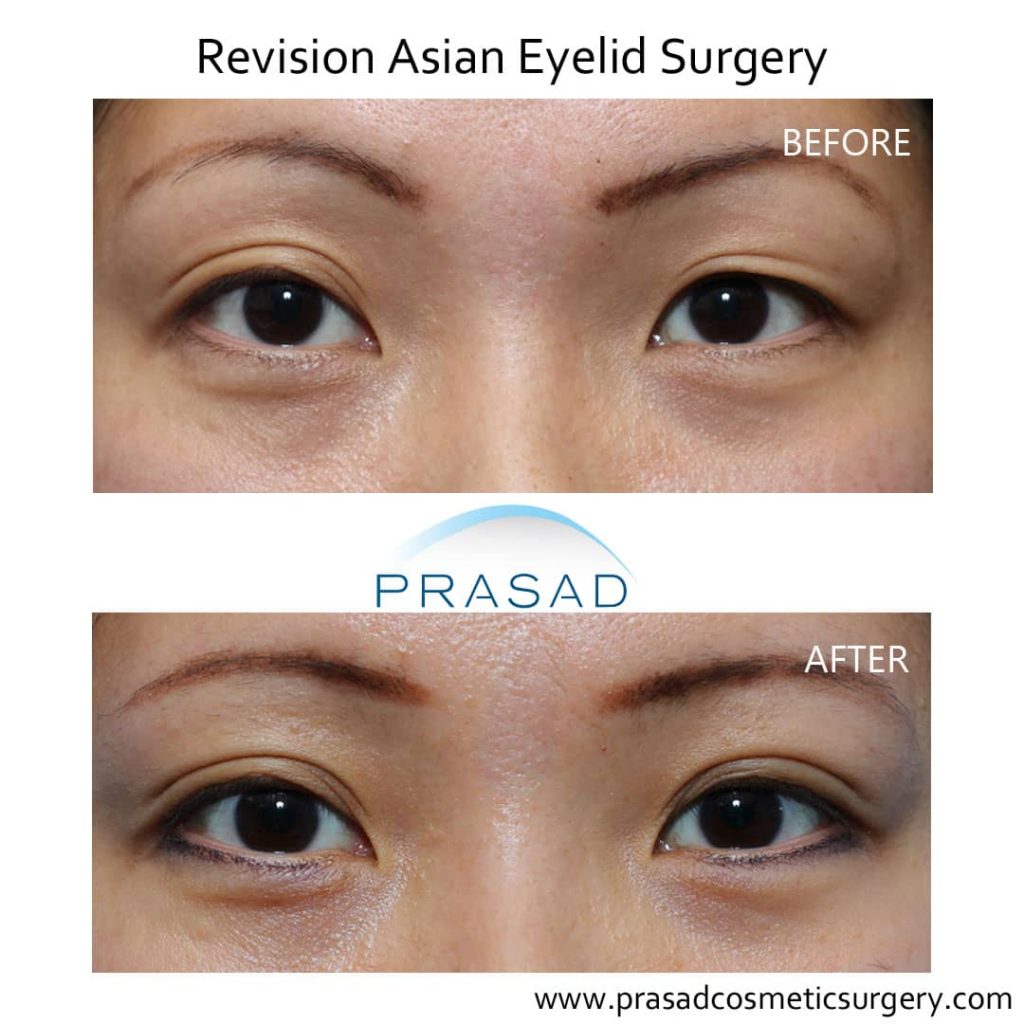 Asian female patient before and after double eyelid blepharoplasty revision performed by Dr. Amiya Prasad