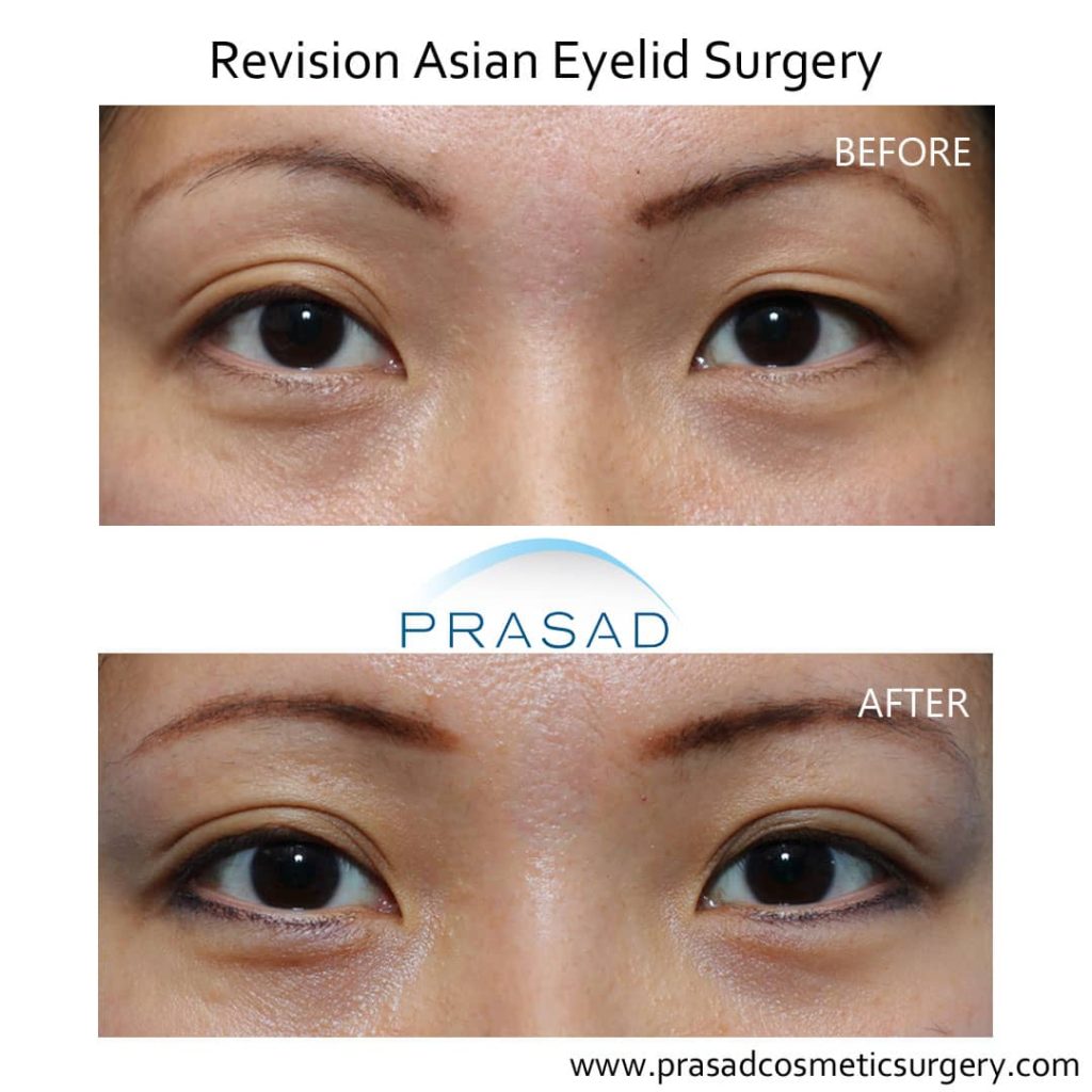 Revisional asian on sale eyelid surgery