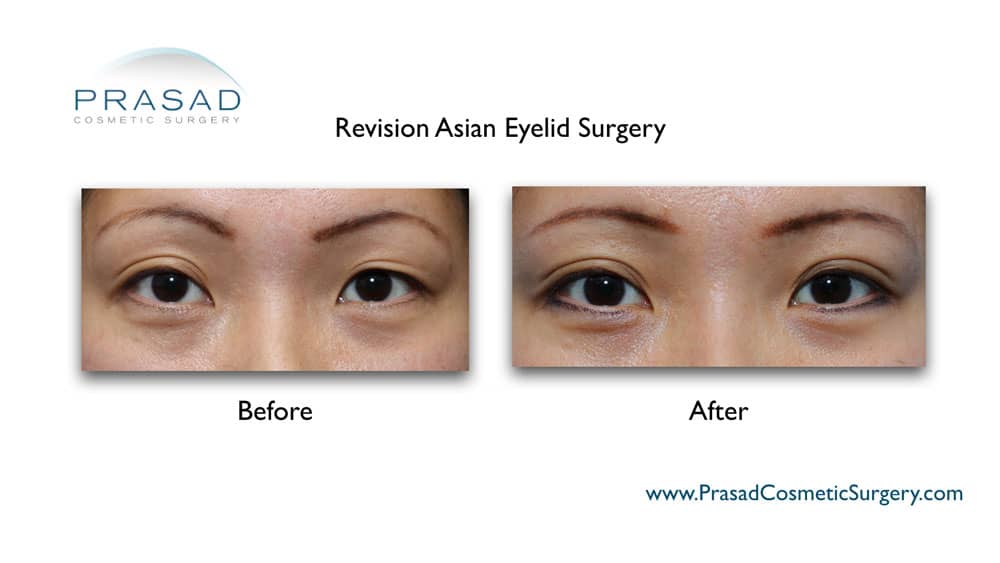 Before and after double eyelid blepharoplasty revision on Asian female patient