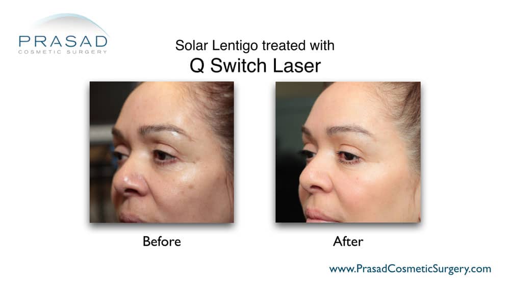 solar lentigo before and after laser treatment for Wrinkles