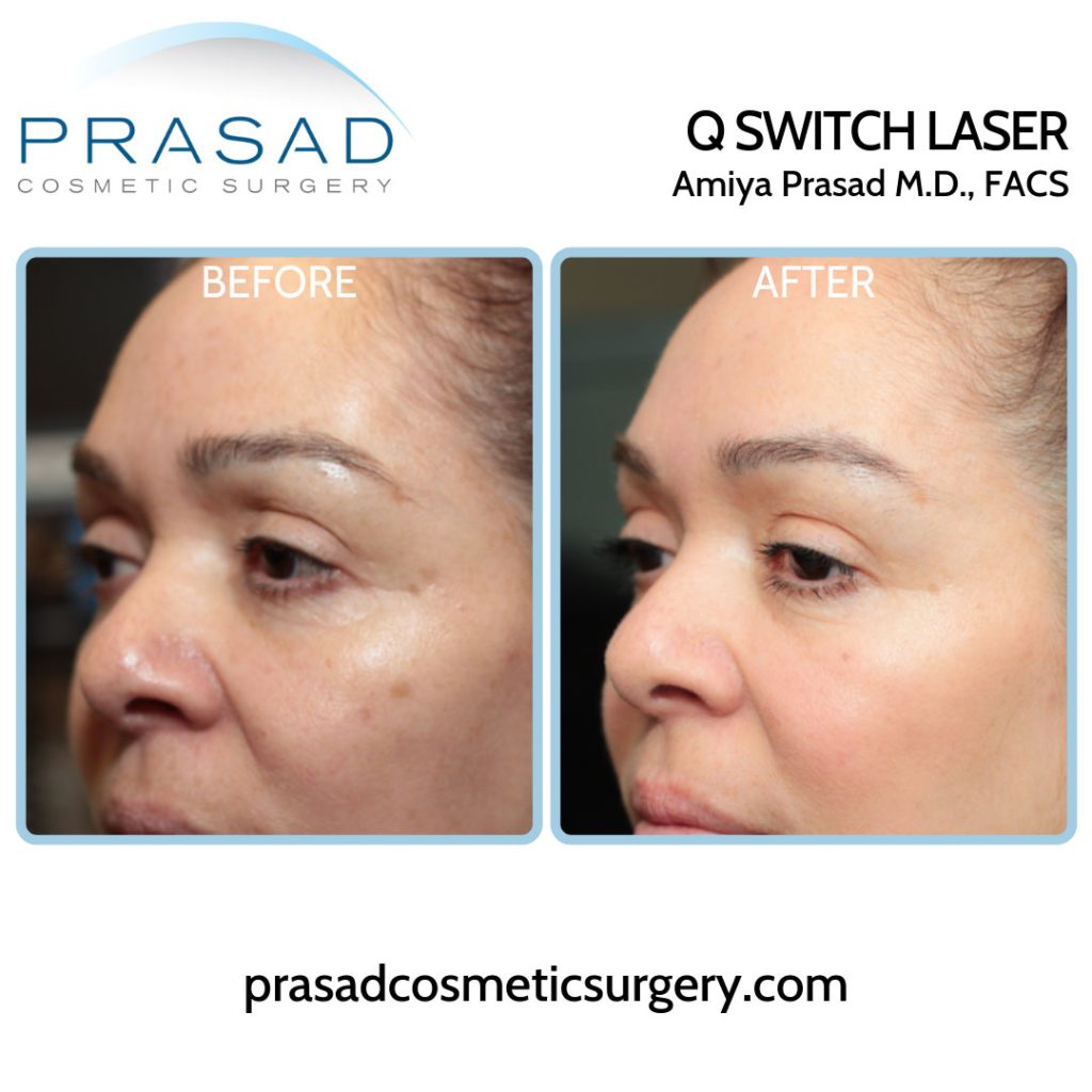 before and after solar lentigo and laser treatment for wrinkles