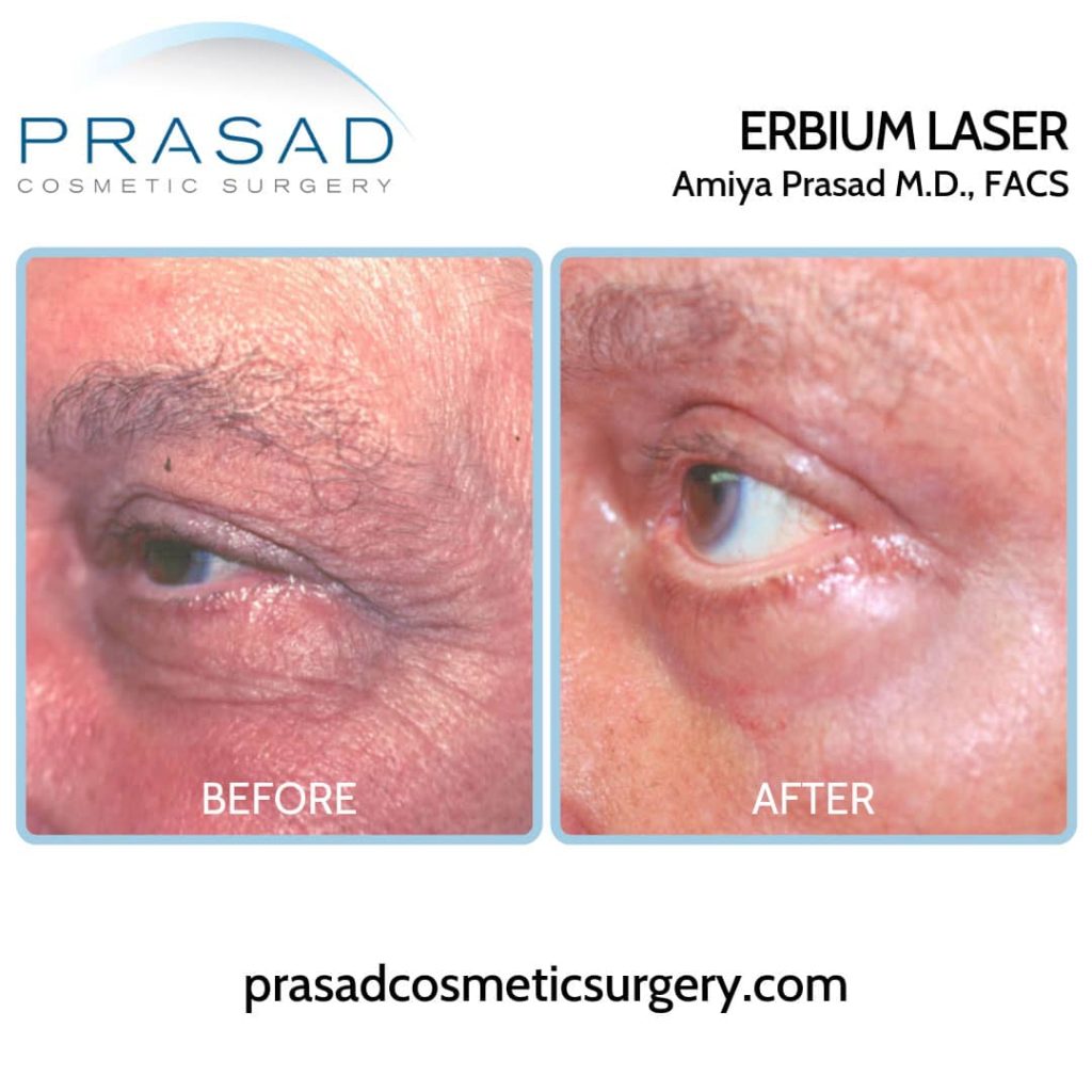 before and after erbium Laser Treatment for Wrinkles around eyes on male patient